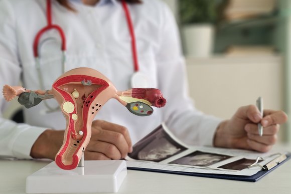 Endometriosis