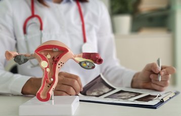 Endometriosis